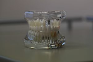 歯とインプラントの違い